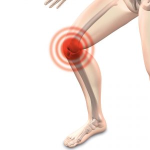 Artrosi al ginocchio